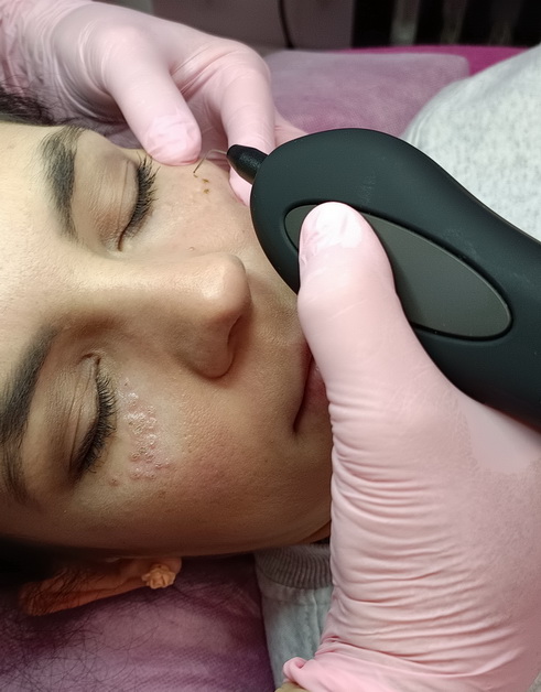 Likwidacja zmian skórnych za pomocą zabiegu plasma